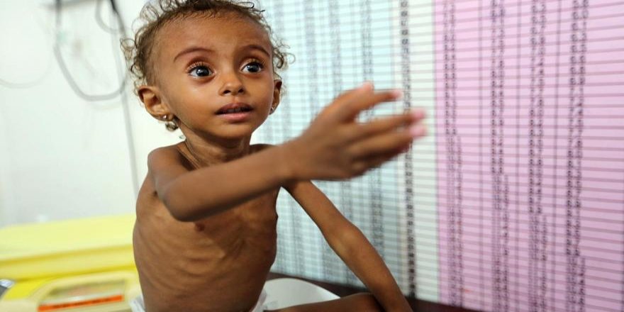 Save The Children: Li Yemenê 100 hezar zarok bi kolêrayê ketîye
